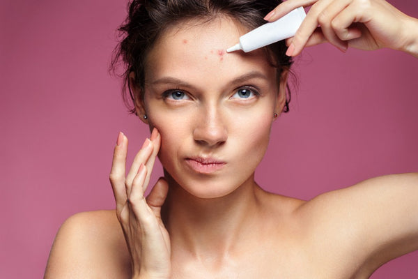 Diagnosing Your Acne and How To Treat It